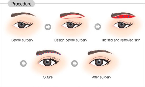 Các loại phẫu thuật thẩm mỹ mắt phổ biến tại Viện thẩm mỹ Icon
