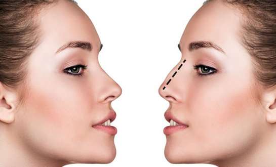 Các phương pháp phẫu thuật nâng mũi