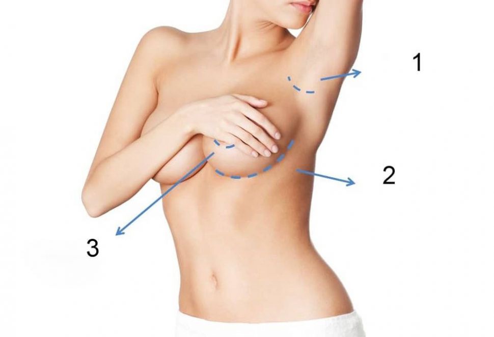 Phẫu thuật đặt túi ngực và những điều cần lưu ý