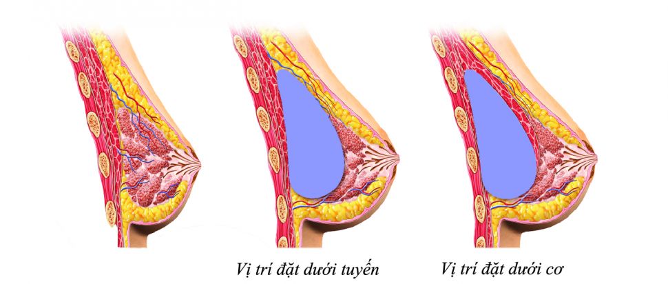 Phẫu thuật đặt túi ngực và những điều cần lưu ý