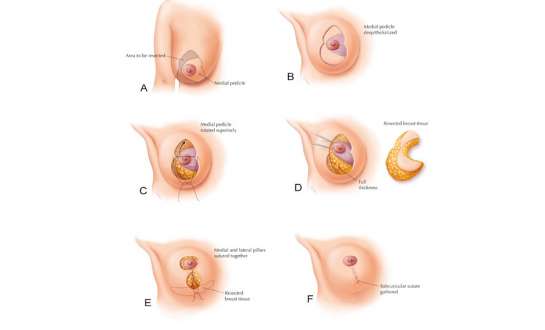 Phẫu thuật thu nhỏ ngực và những điều cần biết