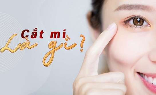 Cắt mí mắt bao lâu thì lành? Lưu ý cần biết để cắt mí đẹp không sẹo