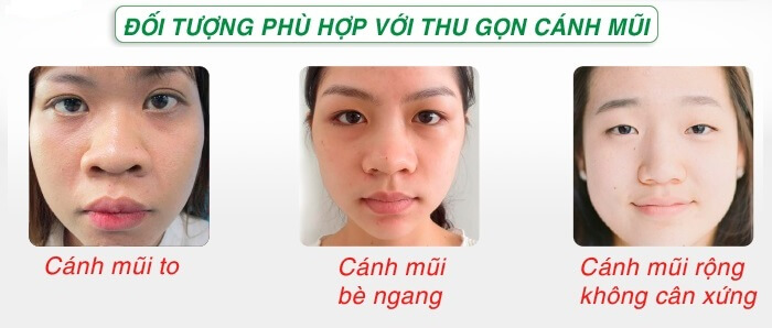 Thu gọn cánh mũi có vĩnh viễn không? Những điều cần lưu ý