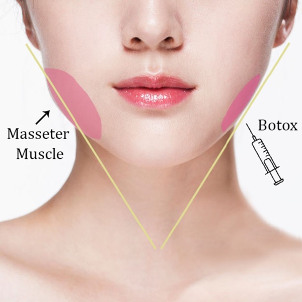 Tiêm botox gọn hàm lợi hay hại? Hiệu quả kéo dài trong bao lâu?