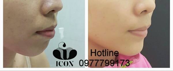 Tiêm botox gọn hàm lợi hay hại? Hiệu quả kéo dài trong bao lâu?