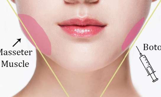 Tiêm botox gọn hàm lợi hay hại? Hiệu quả kéo dài trong bao lâu?