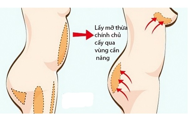 Những điều cần biết về nâng ngực bằng mỡ tự thân