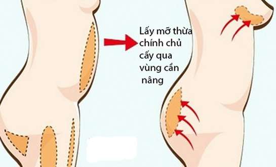 Những điều cần biết về nâng ngực bằng mỡ tự thân