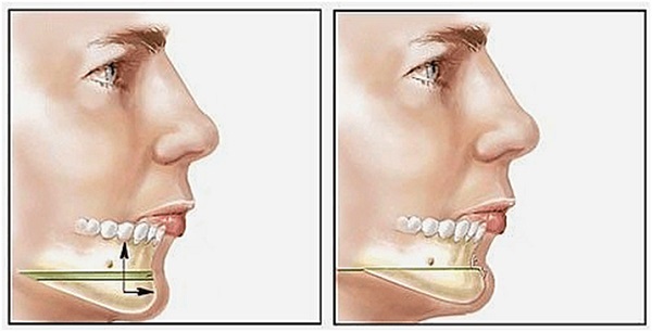 Cằm lẹm là gì? Nguyên nhân và cách khắc phục như thế nào?