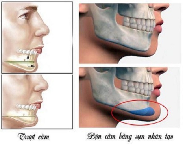 Cằm lẹm là gì? Nguyên nhân và cách khắc phục như thế nào?