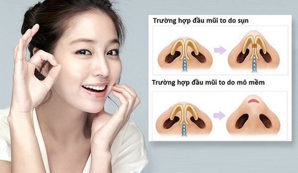 Thu nhỏ đầu mũi là gì? Những điều cần lưu ý khi thu gọn đầu mũi