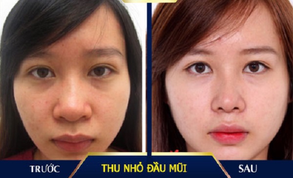 Thu nhỏ đầu mũi là gì? Những điều cần lưu ý khi thu gọn đầu mũi