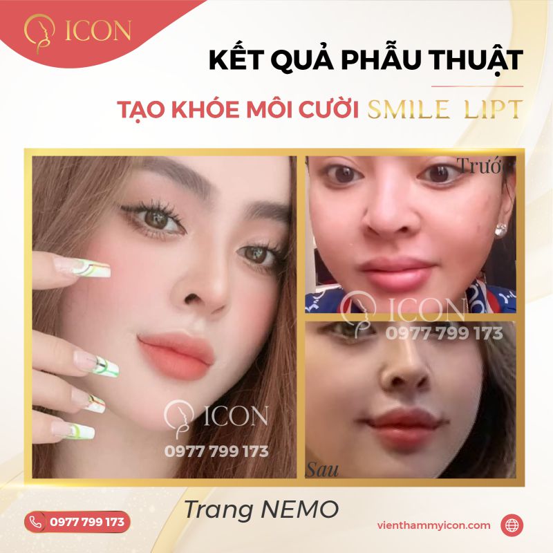 Phẫu thuật tạo khóe môi cười Smile Lipt độc quyền từ Hàn Quốc