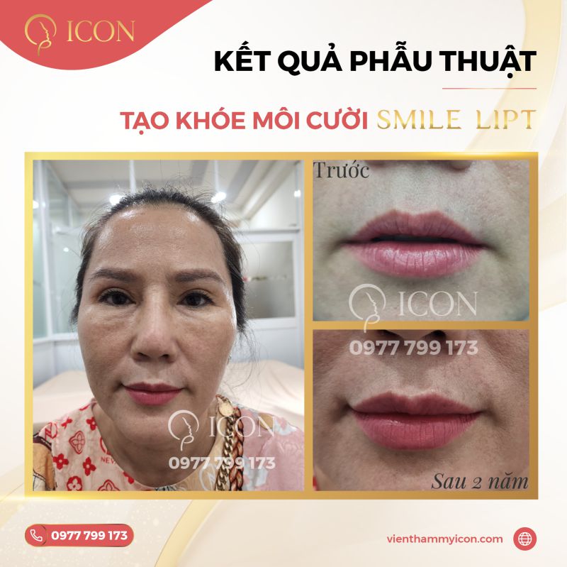 Phẫu thuật tạo khóe môi cười Smile Lipt độc quyền từ Hàn Quốc