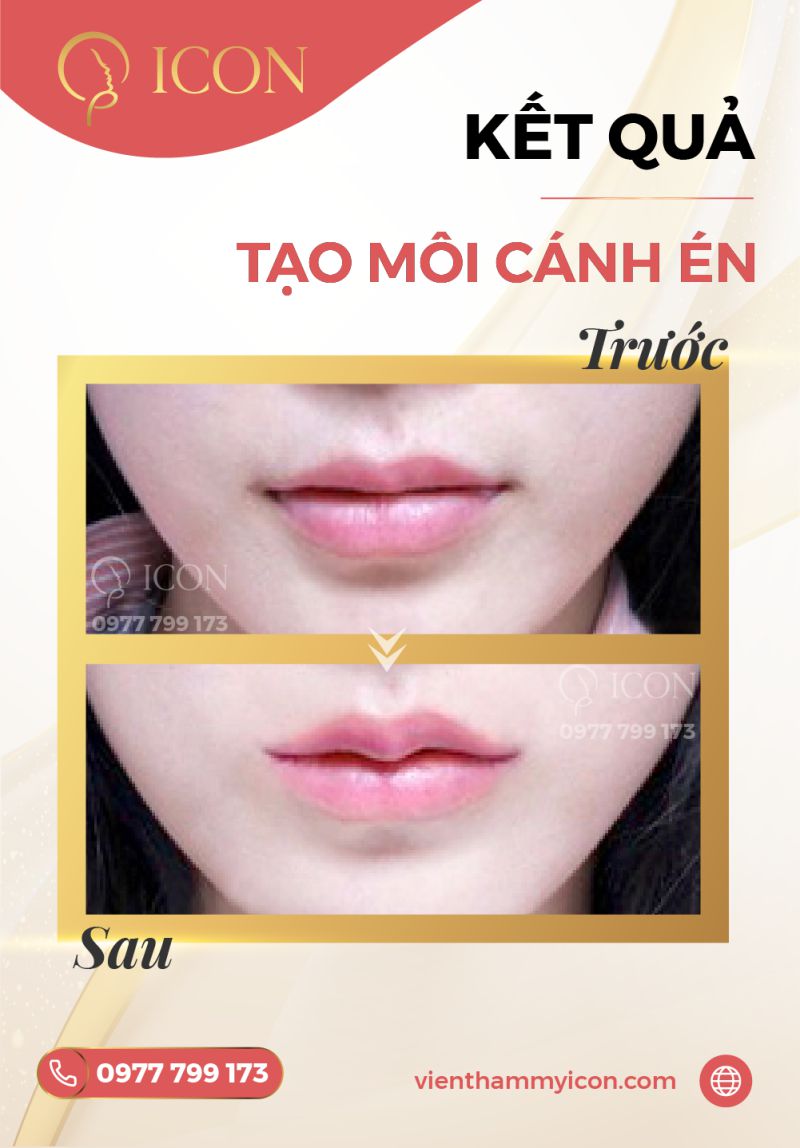 Môi cánh én là gì? Tướng số và cách sở hữu môi cánh én đẹp như sao Hàn