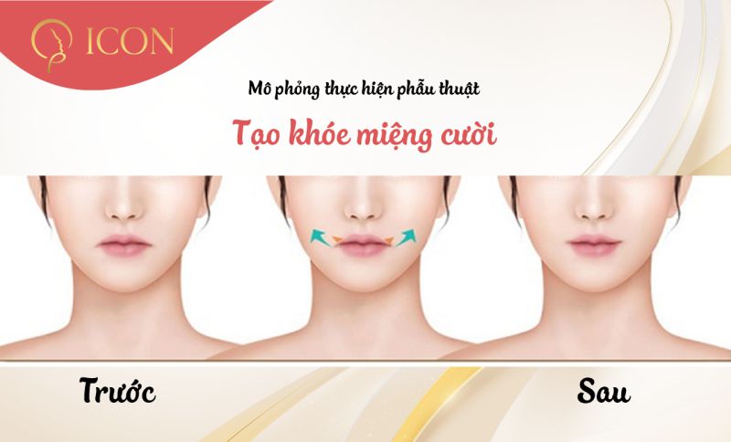 Cách tạo khóe miệng cười đẹp tự nhiên xinh xắn quyến rũ nhất