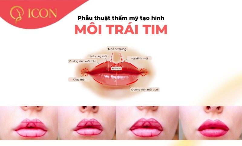 Chia sẻ kinh nghiệm cắt môi trái tim bạn cần biết