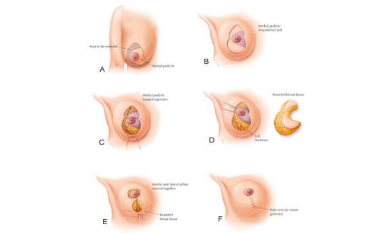 Phẫu thuật thu nhỏ ngực và những điều cần biết